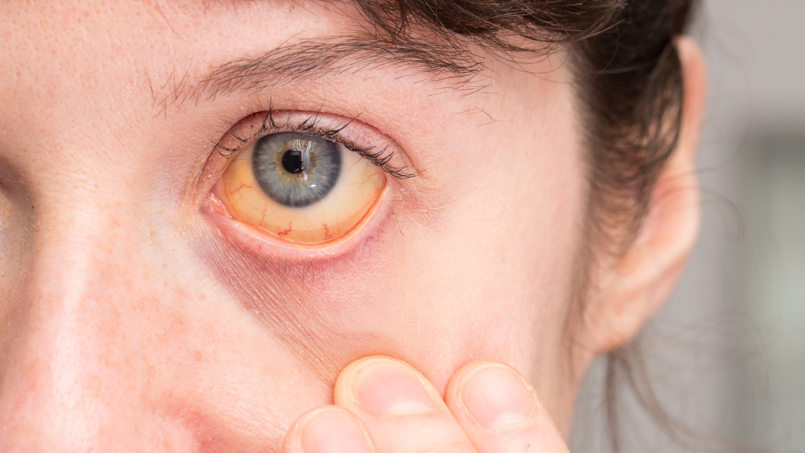 Yellowing Under The Eyes Infoupdate
