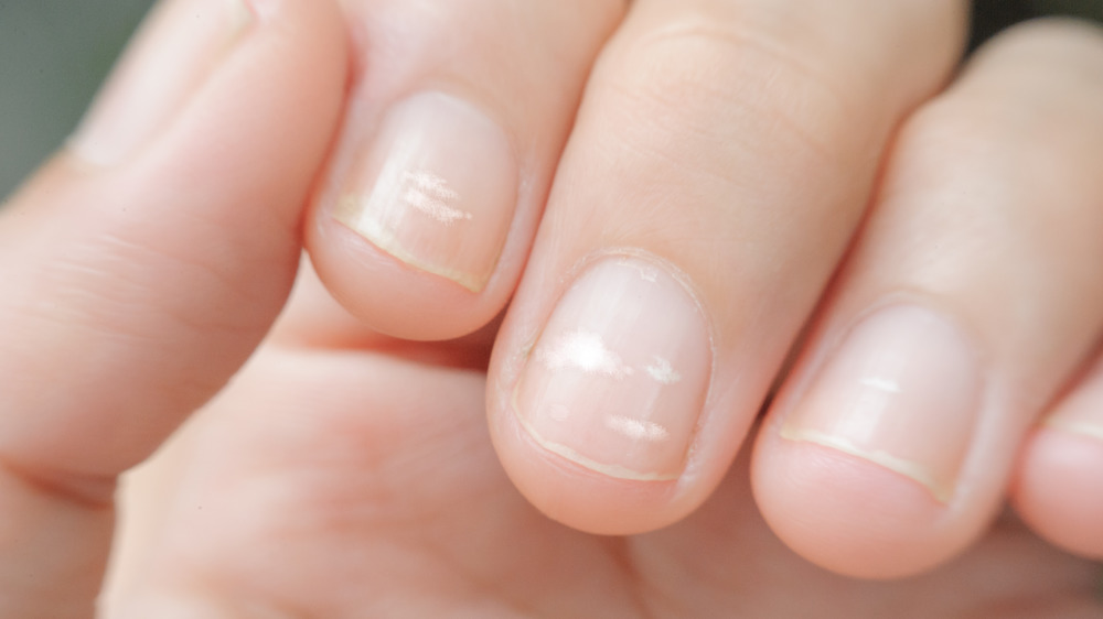 White spots on fingernails