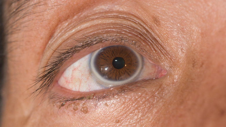 Telling the Difference Between Pink Eye & Styes | Calgary