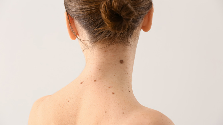 Mole on back of neck 