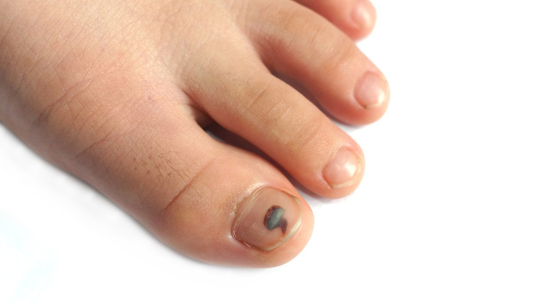 What Does It Mean When Your Toenail Turns Black?