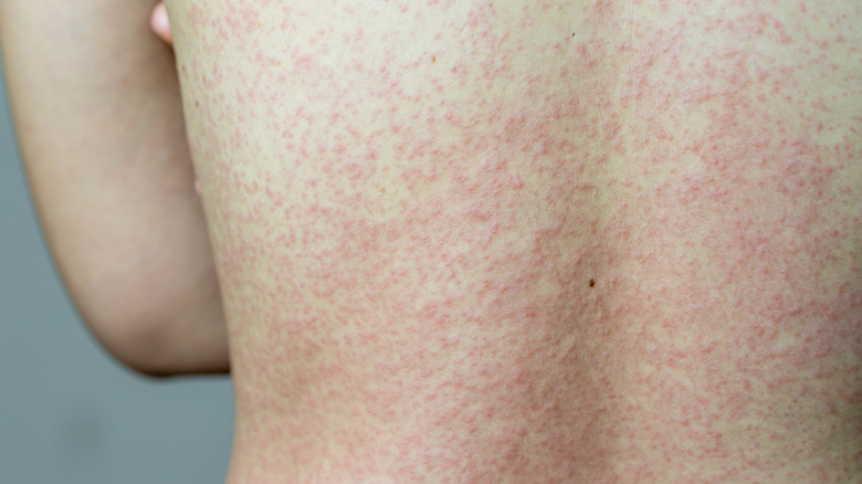 Woman with a shingles rash on her back