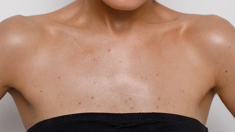 Rash on skin