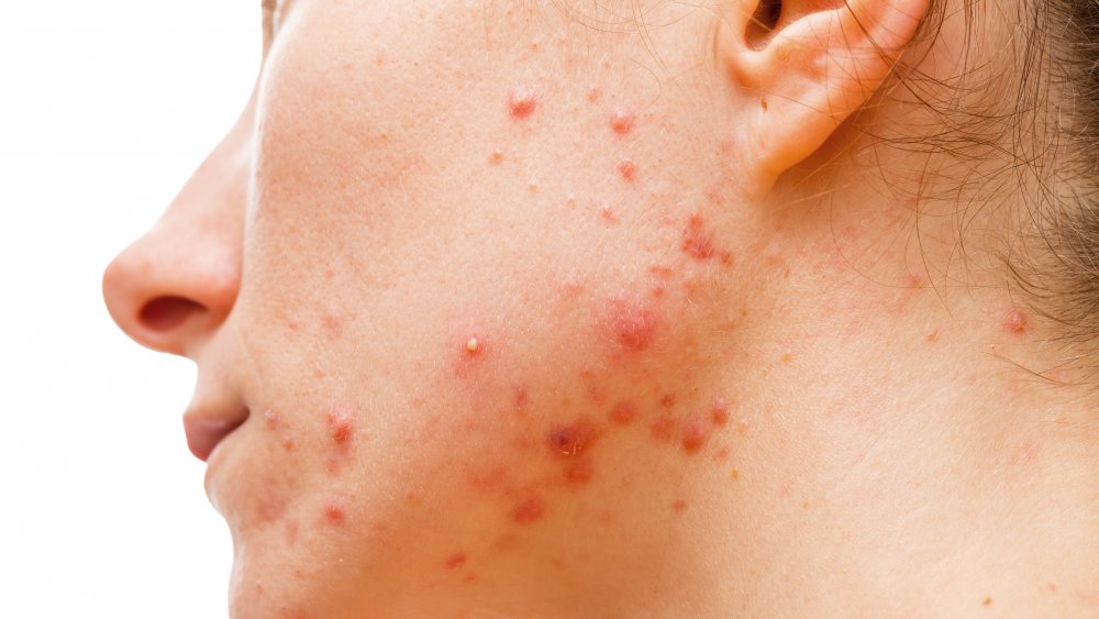 Cystic acne