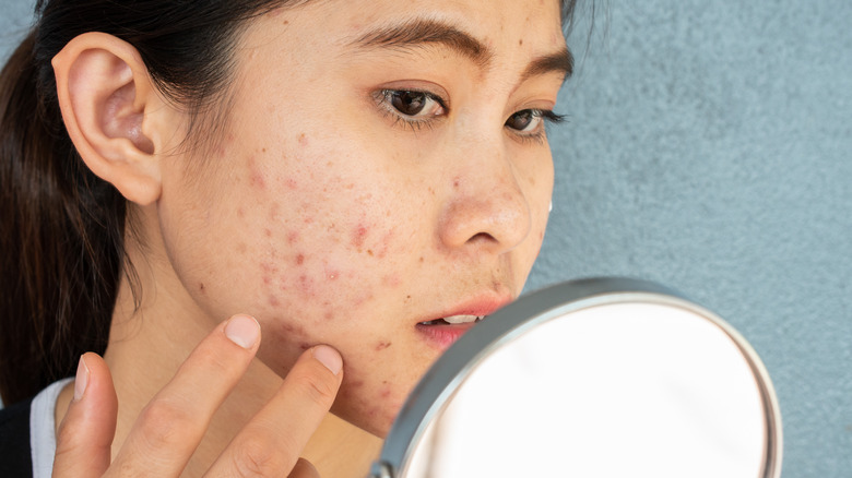 Woman looking at acne scars 