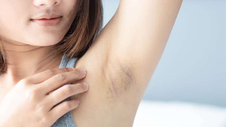 A woman with underarm discoloration