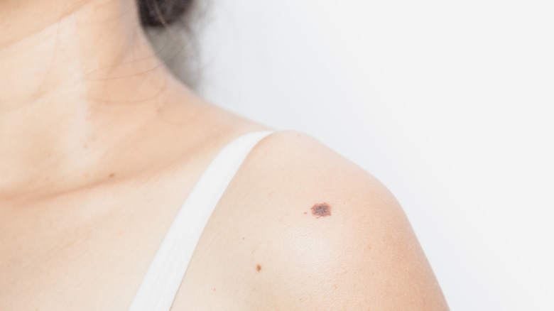 Woman bearing shoulder mole