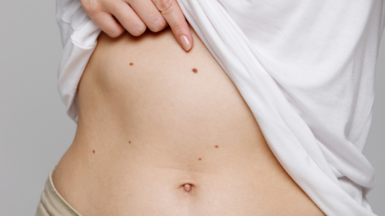 mole on stomach