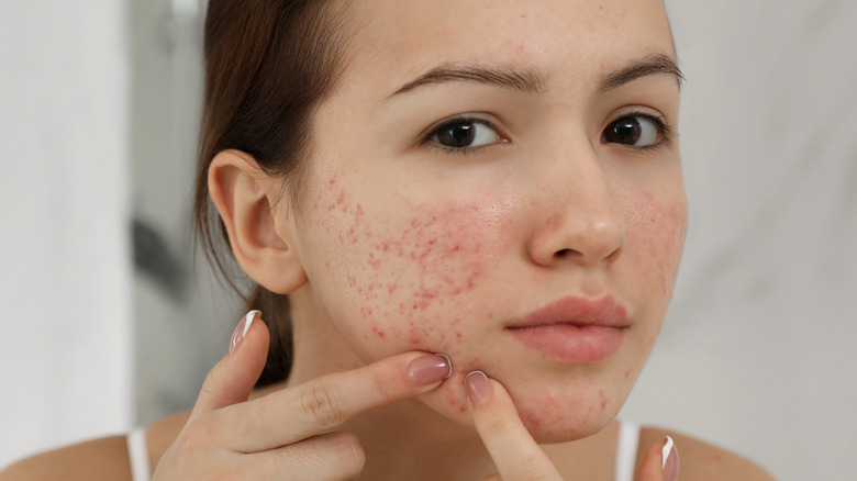 What It Really Means If You Have A Pimple In One Of These Places