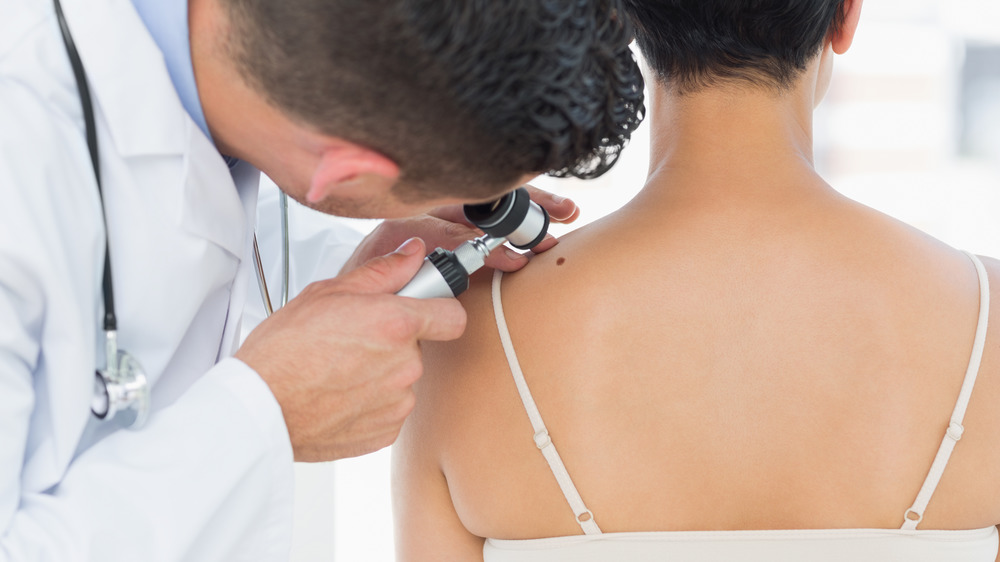 Doctor looking at back mole