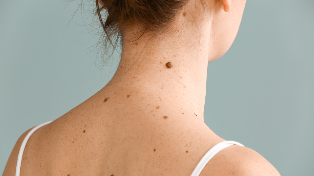 Moles on back and neck