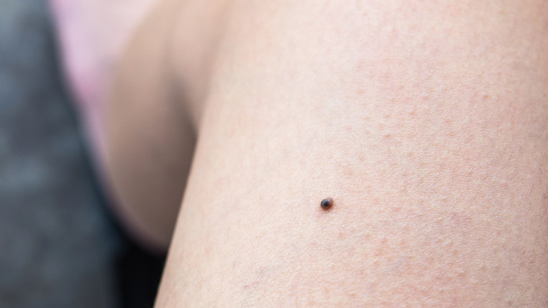 Mole on woman's leg