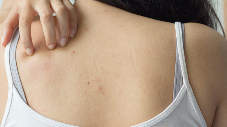 Woman itching acne on back 
