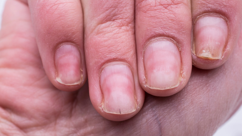 What It Really Means When Your Nails Are 'Lifting' (And How To Prevent It)