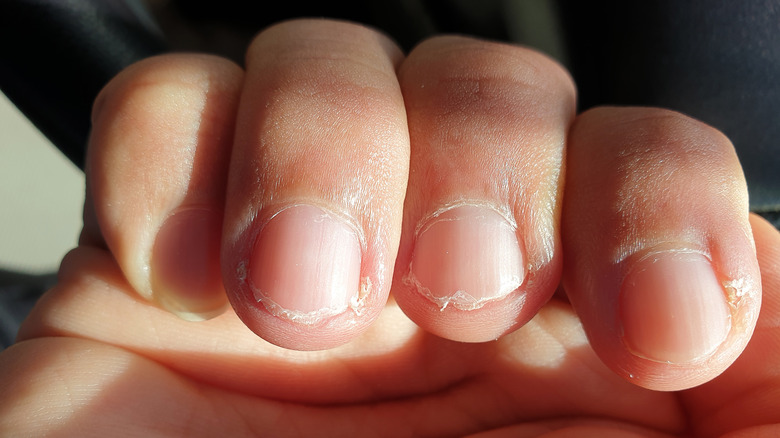 What Really Happens To Your Body When You Bite Your Nails