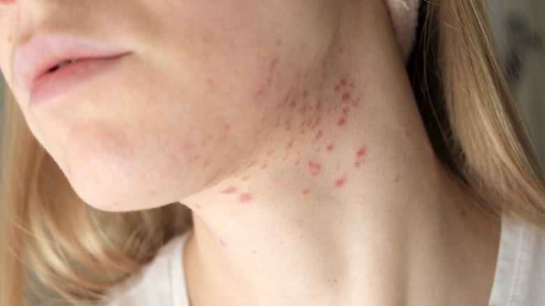 Woman with acne on neck