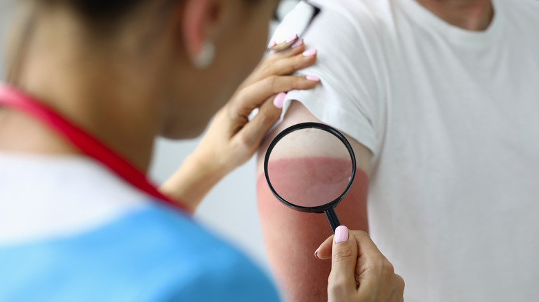 Nurse examining sunburn with a magnifying glass