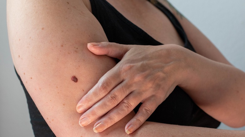 Woman's arm with mole on it