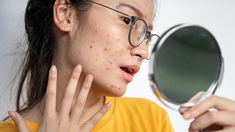 woman in yellow looking at acne scars
