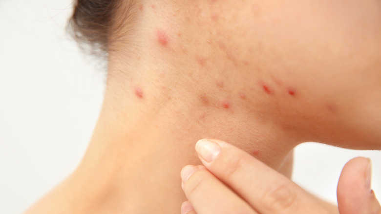 What You Don t Know About Pimples