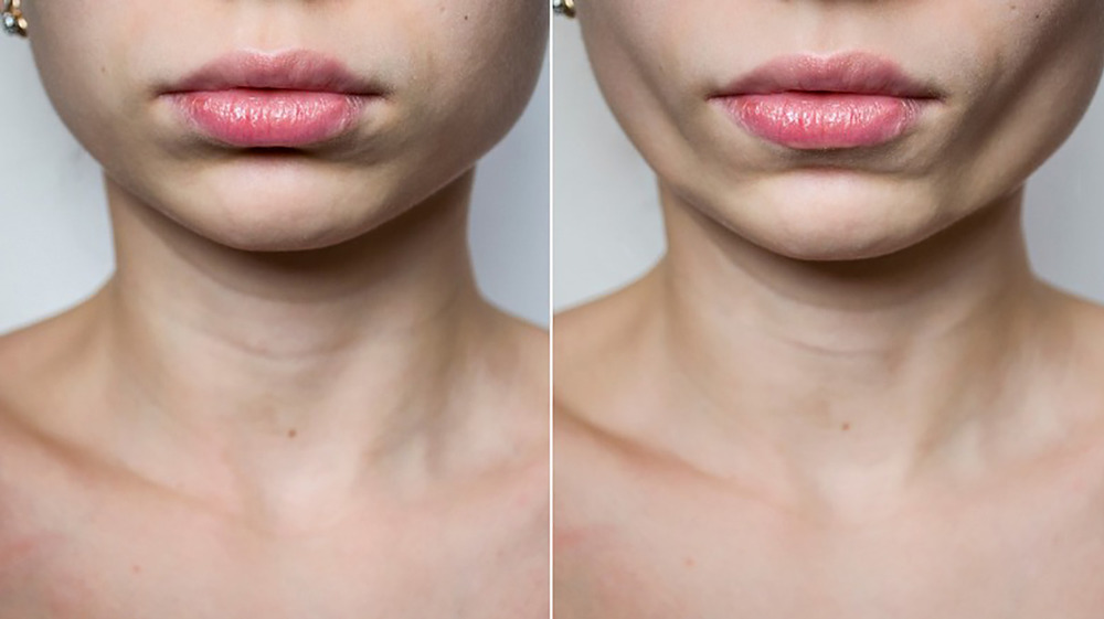Buccal fat removal side-by-side photos