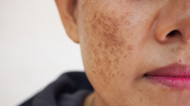 Woman with damaged skin