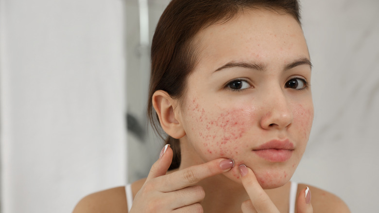 Teen girl with acne and pimples