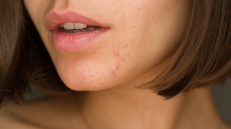 Close-up of woman with acne