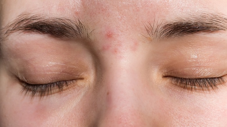 Woman with acne between eyebrows