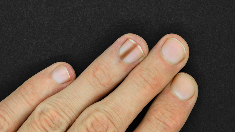Black lines on nails