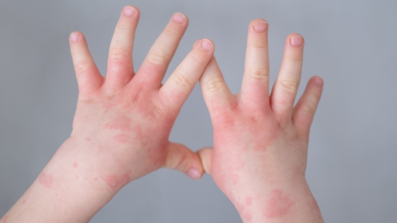 Child hands with eczema