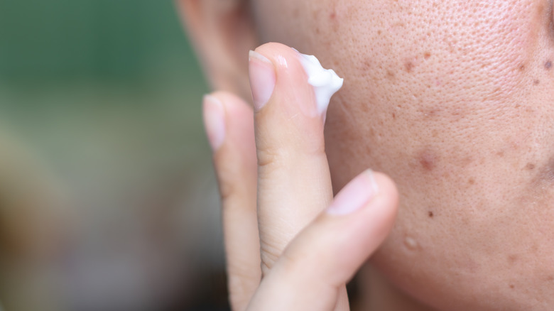 Woman applying spot cream to face