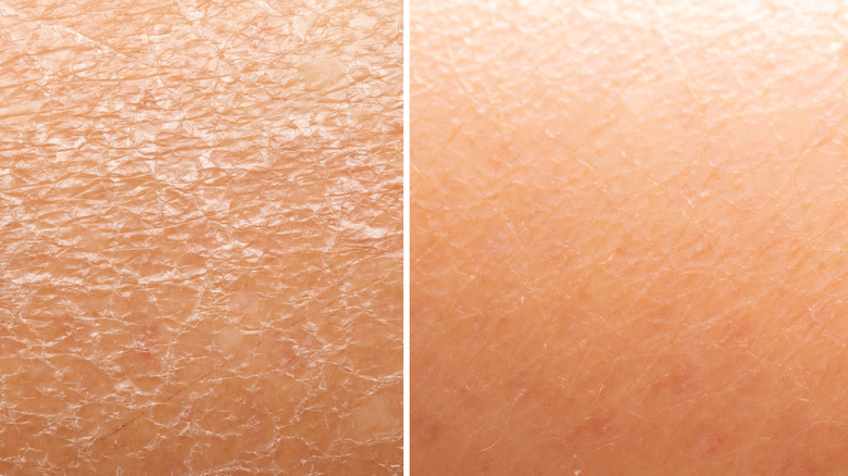 dry skin versus moisturized skin
