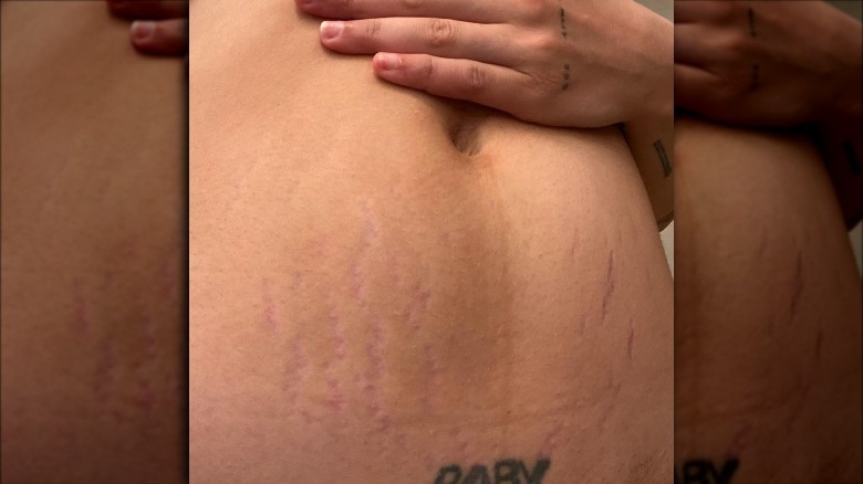 Halsey's tummy postpartum