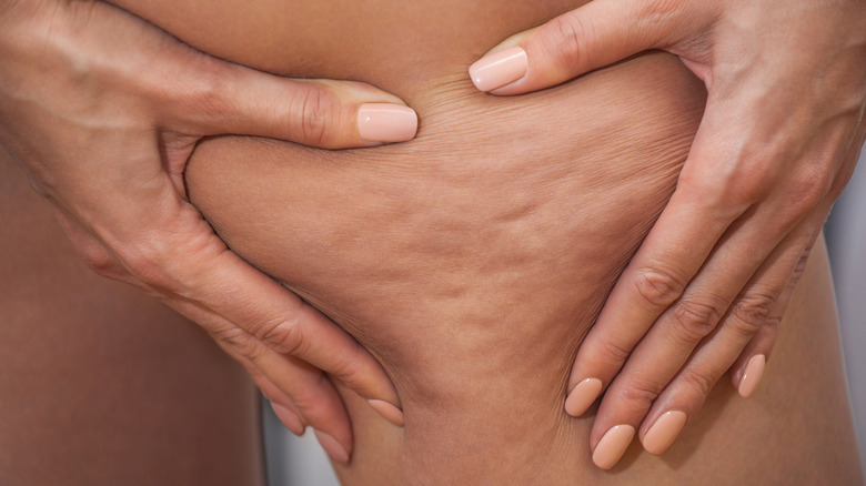 woman's hands frame cellulite on her leg