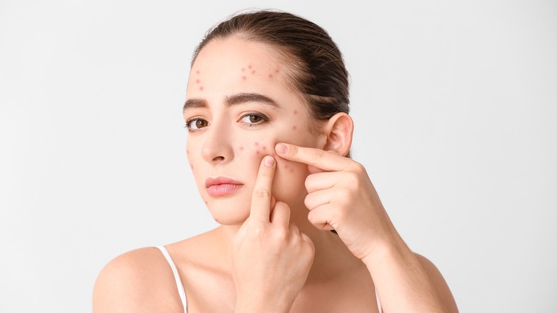 Woman with acne 