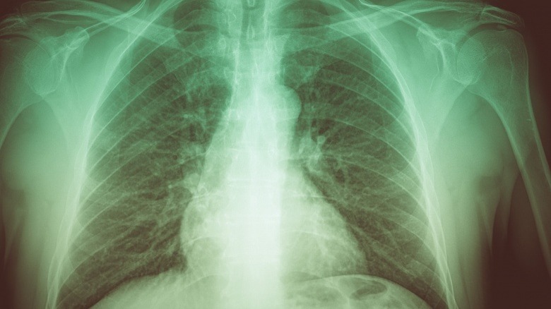 ribs x-ray