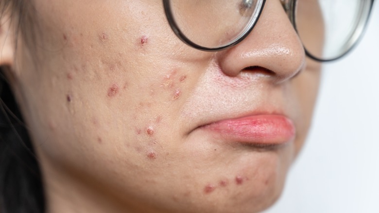 woman with acne frowning