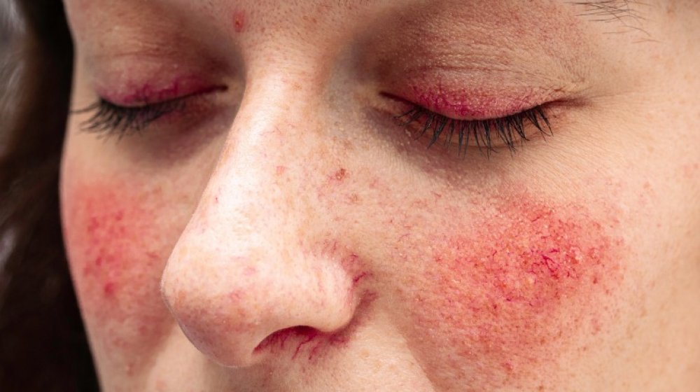 Woman with rosacea