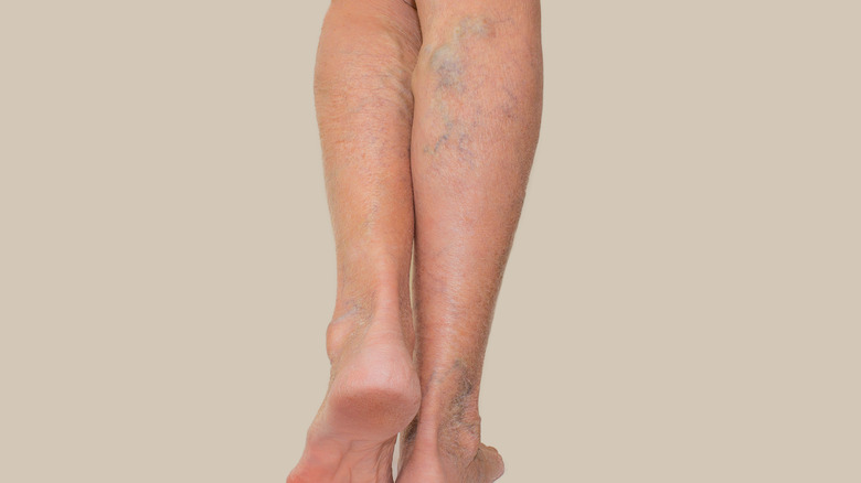 Varicose veins on legs